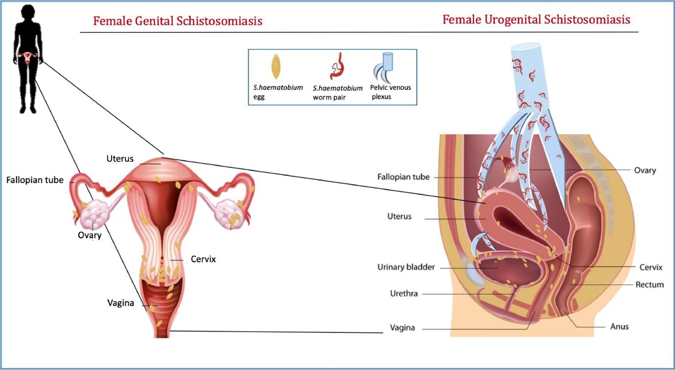 Female genital schistosomiasis and urogenital schistosomiasis anatomy. Image from Sturt et al., 2020