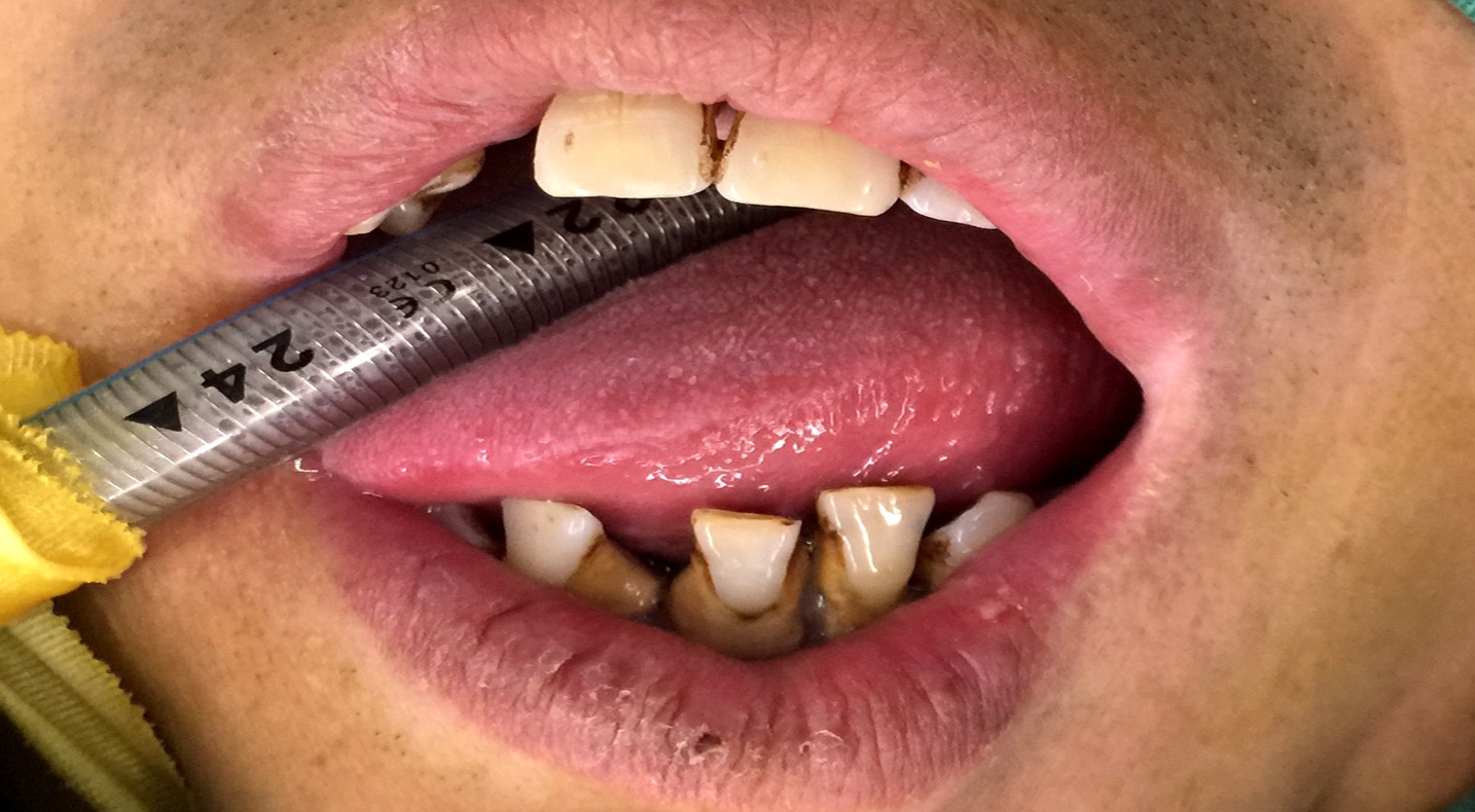 the fragile dental structure the fragile dental structure