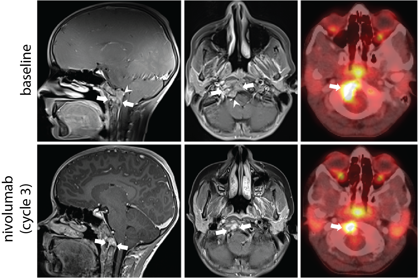 Sagittal (left) and axial (middle) post-contrast MRI and concurrent PET/CT (right) images prior to nivolumab therapy (top panel) demonstrate an enhancing solid mass involving the clivus, basiocciput, and right occipital condyle (arrows), with effacement of the premedullary cistern and indentation upon the brainstem (arrowheads) and a large focus of metabolic activity at the tumor site (SUVmax 8.2; arrow). Follow-up images (lower panels) 3 months after the initiation of nivolumab therapy show substantial decrease in size of the mass (arrows), with resolution of mass effect upon the brainstem. The concurrent PET/CT image shows attendant decrease in the region of metabolic activity (SUVmax 6.0; arrow), indicating a partial radiographic response
