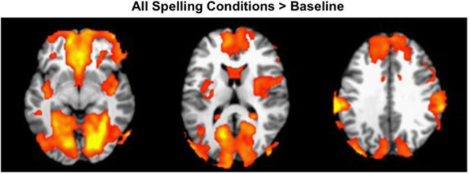 Editorial Summary—The method of educational assessment affects children’s neural processing and performance: behavioural and fMRI Evidence