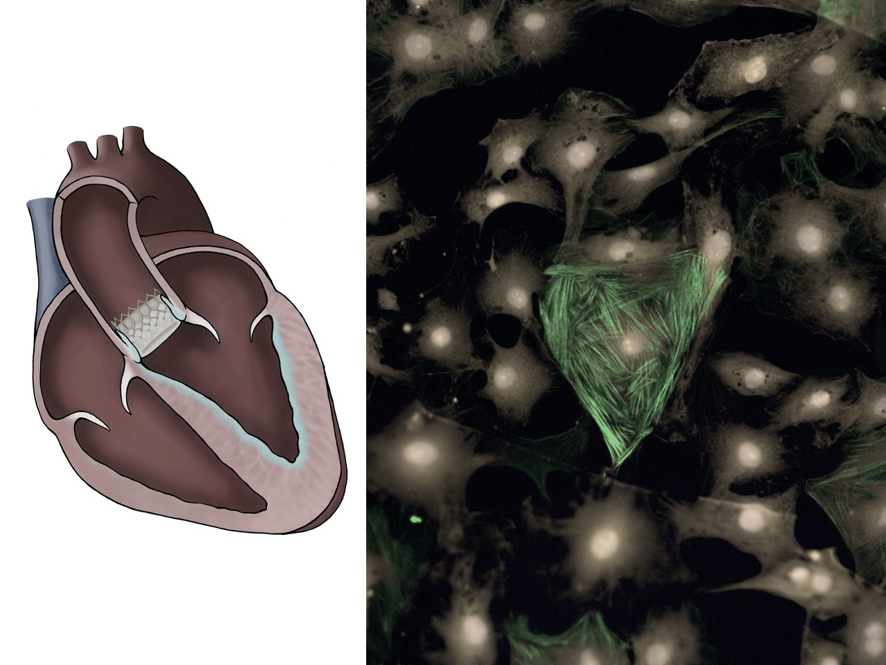 Transcatheter aortic valve replacements alter circulating serum factors to mediate myofibroblast deactivation 