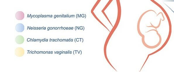 Hidden Threat: Mycoplasma genitalium Infection in Pregnancy Linked to Lower Birth Weight Babies