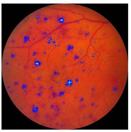 Artificial intelligence predicts diabetic retinopathy disease progression in individual patients