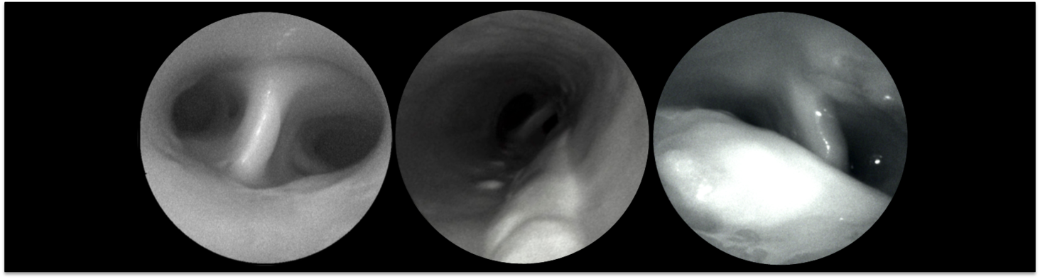 Imaging atherosclerosis from the inside
