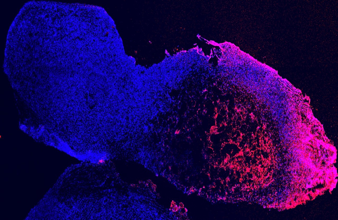 A one-shot combination therapy for triple-negative breast cancer