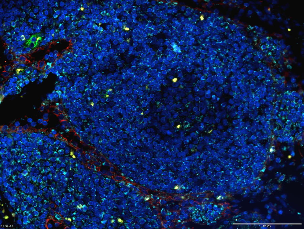 VLA-4 and its complicated relationship with the BCR in chronic lymphocytic leukemia 