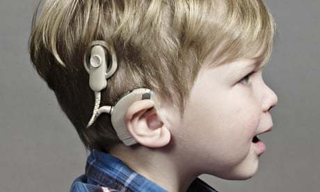 Optimize the bionic ear to get it in better shape