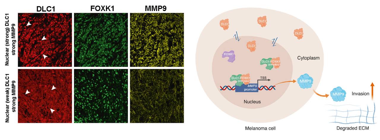 A well-known tumor suppressor Deleted in Liver Cancer 1 (DLC1) is oncogenic in melanoma 