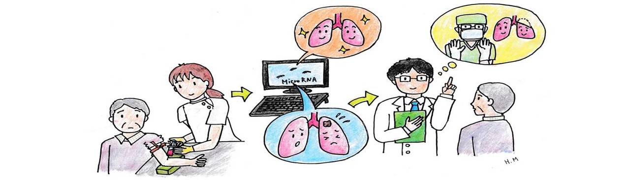 Serum miRNA predicts resectable lung cancer