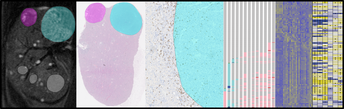 HIF-1α and HIF-2α differently regulate tumour development and inflammation of clear cell renal cell carcinoma in mice 