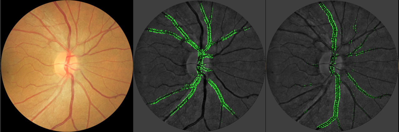 A deep-learning system for the assessment of CVD risk via the measurement of retinal-vessel calibre
