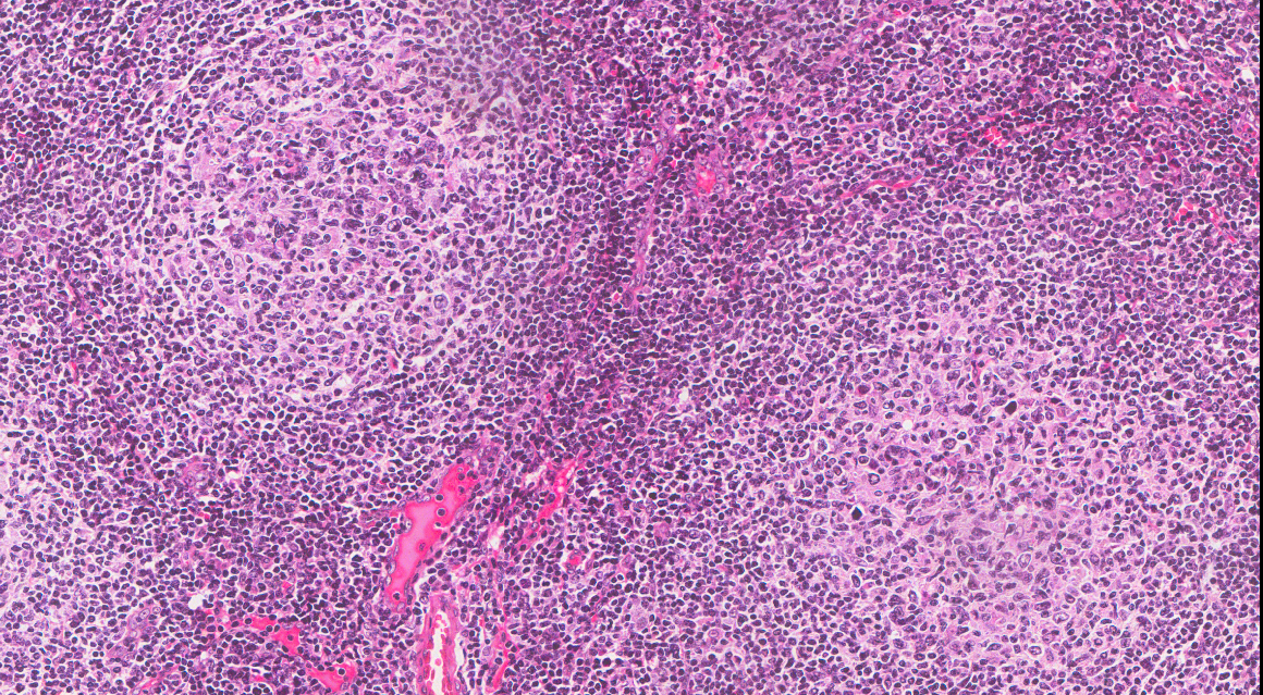 Single nucleotide variants in cytokine genes alter the susceptibility and aggressiveness for follicular lymphoma