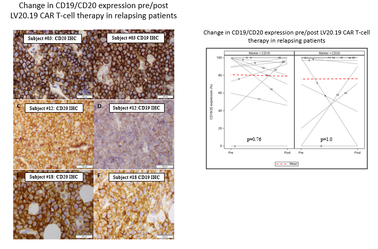 Point of Care Manufacturing and Dual Targeting CARs in B-cell Malignancies