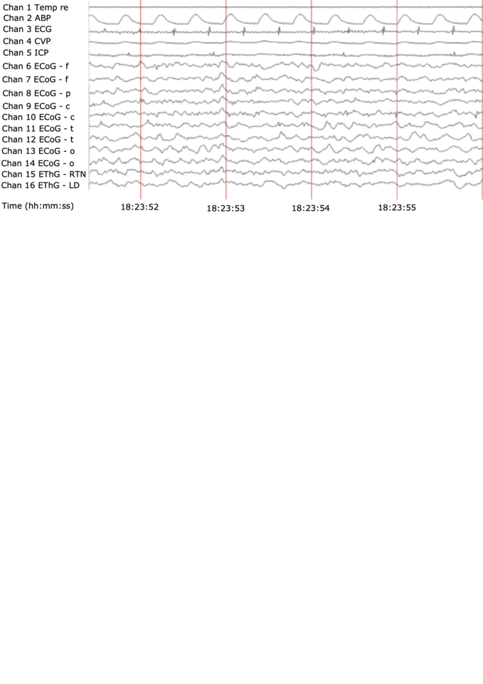 Titrating neural electrical correlates of consciousness