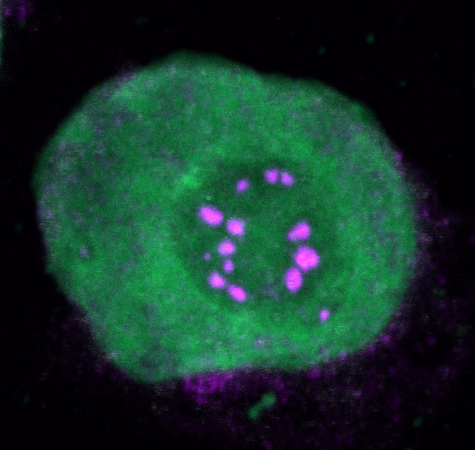Biomolecular Condensation Drives Oncogenic Gene Expression