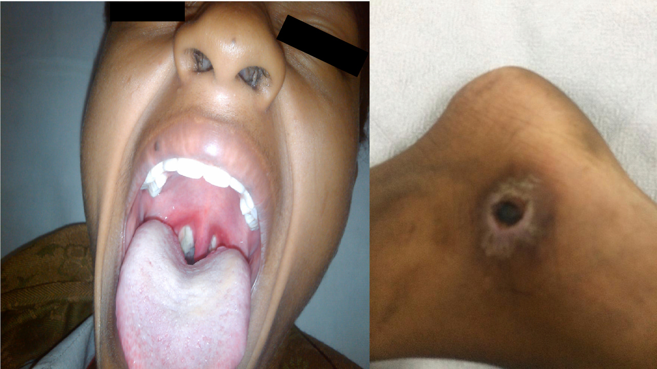 Diphtheria: A re-emerging major global threat