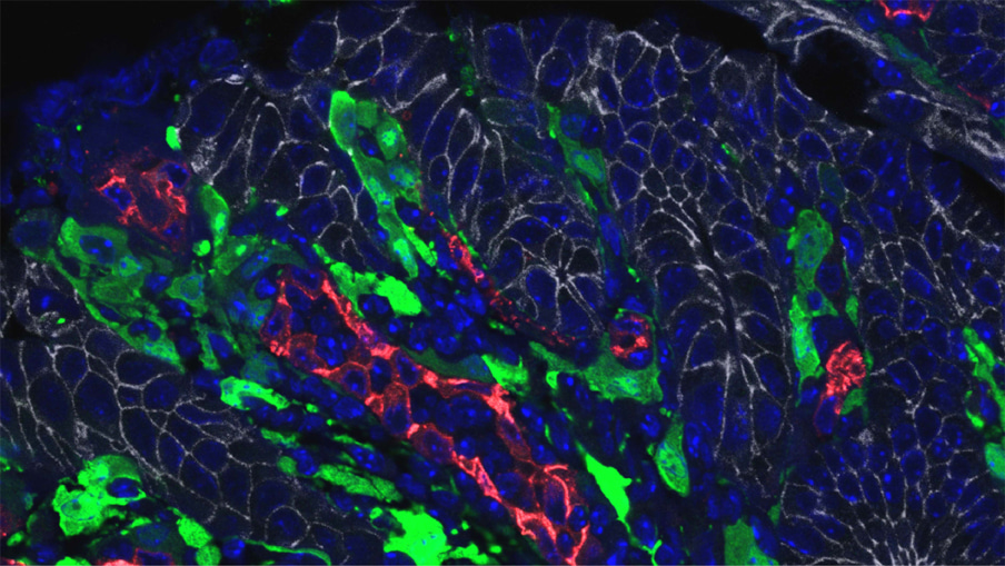 Interleukin-11-expressing fibroblasts have a unique gene signature
correlated with poor prognosis of colorectal cancer
