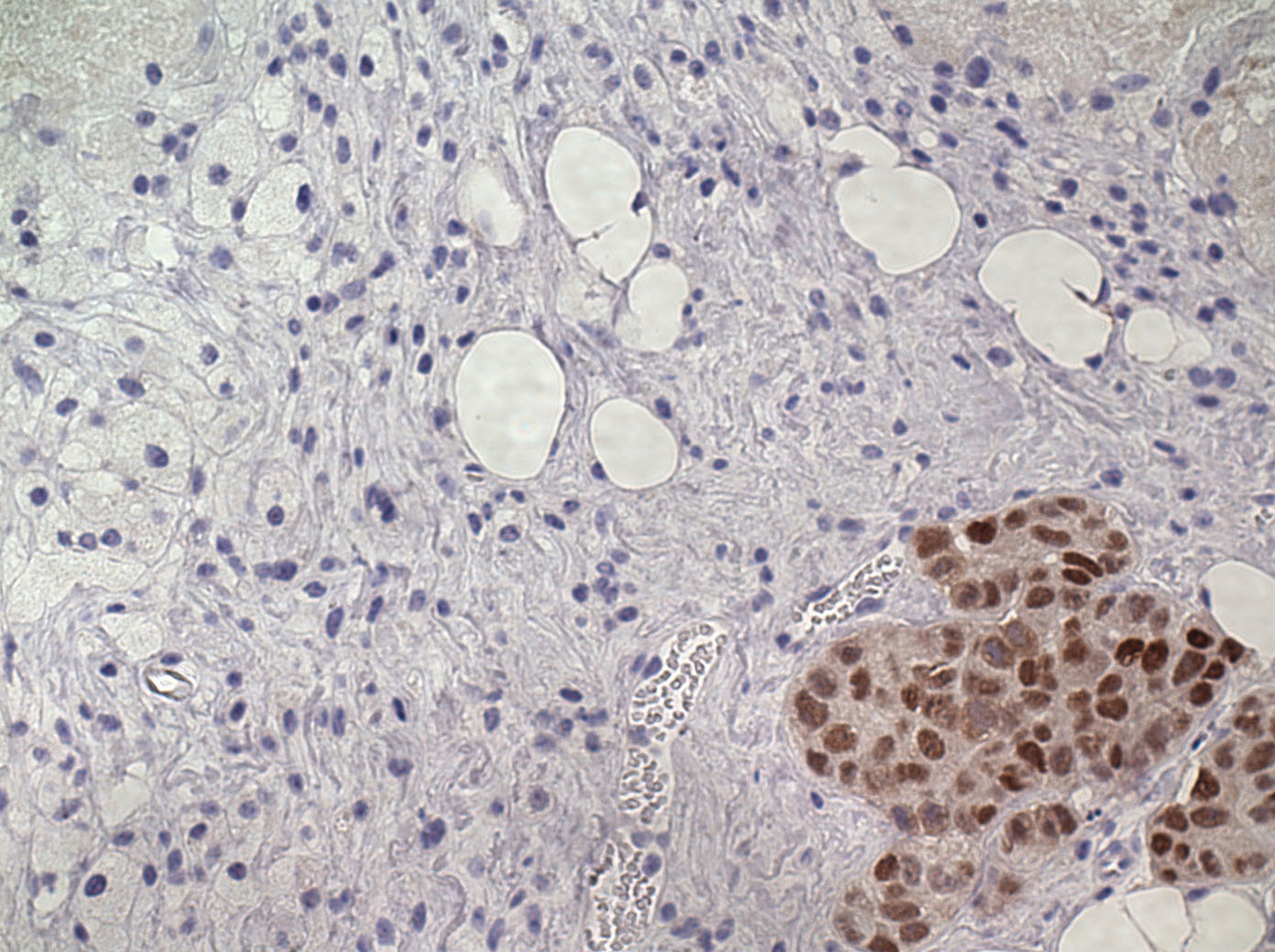 High estrogen receptor alpha activation confers resistance to estrogen deprivation and is required for therapeutic response to estrogen in breast cancer
