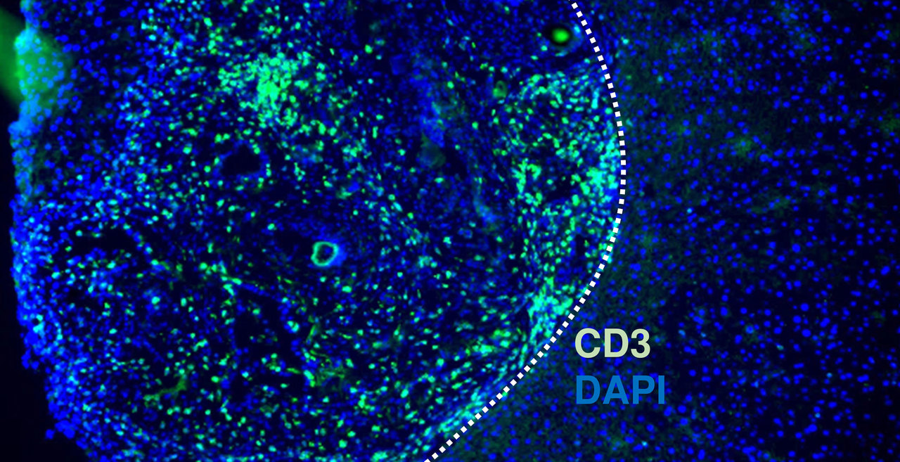 Precision mouse model for patients with gallbladder cancer that enables analysis of local tumor immune responses