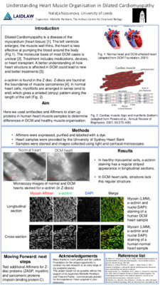 Research poster: Understanding Heart Muscle Organisation in Dilated Cardiomyopathy