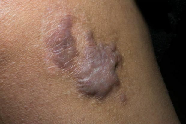 What would you advise for a scar like this?