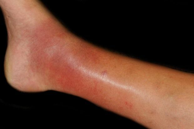 Swollen ankles: causes and management