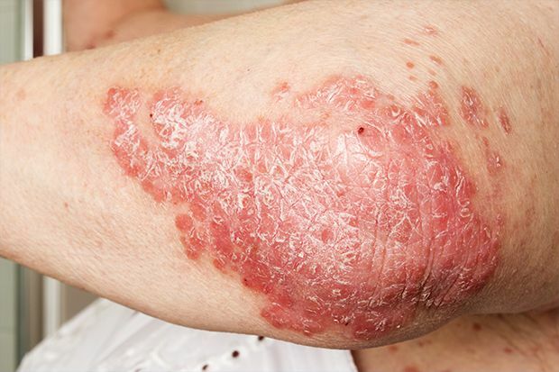 What’s happening with my eczema? 