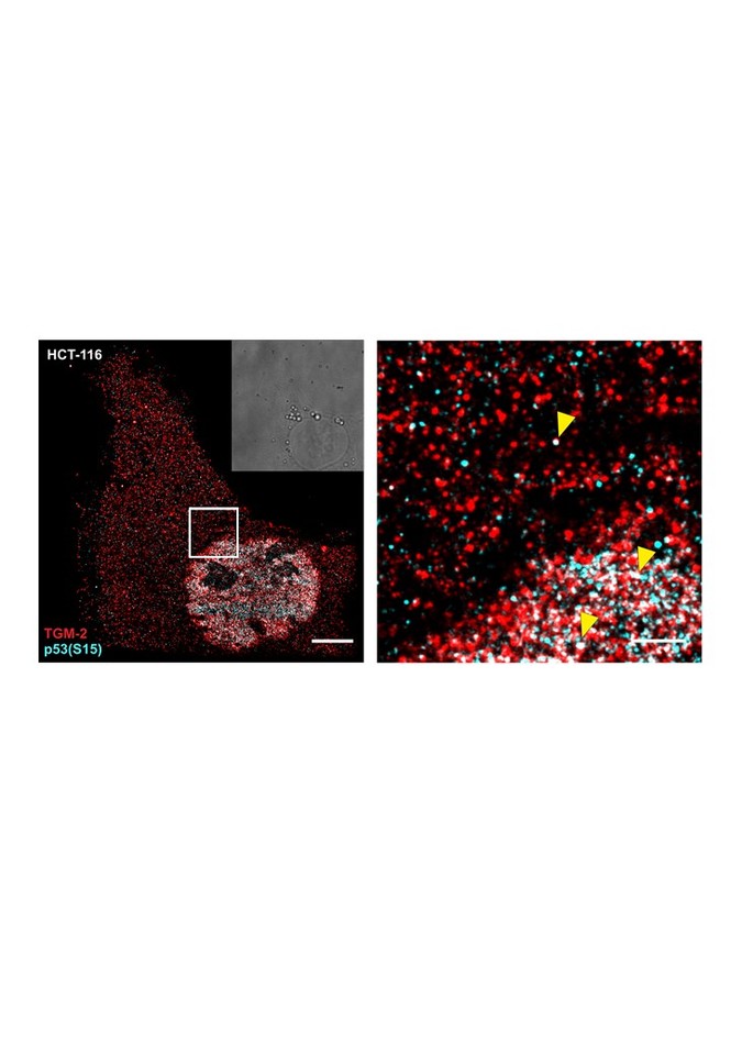 Transglutaminase 2 activation: an alternative way to suppress p53 function in colorectal cancer