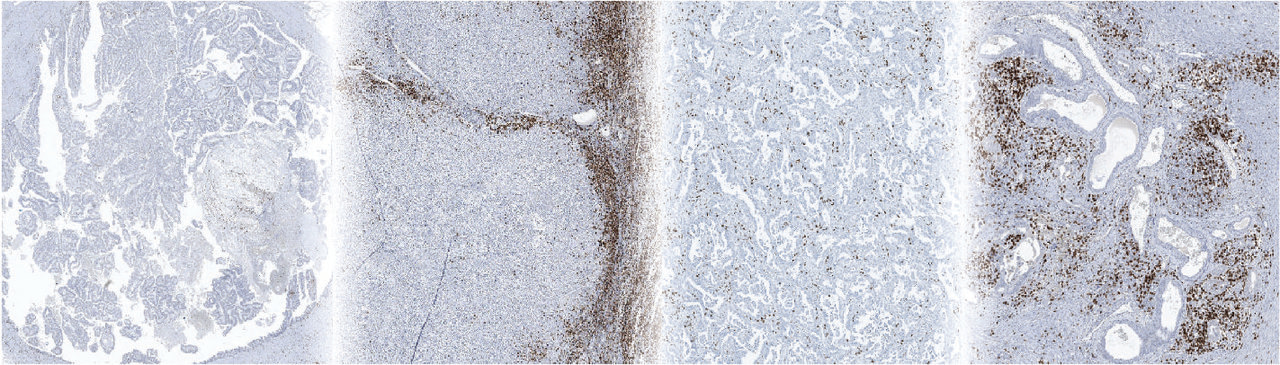 From patients to tumor avatars: A journey towards personalized immunotherapy research