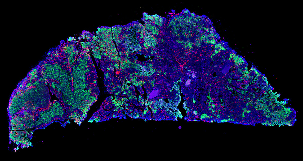 Refractoriness of STING therapy is relieved by AKT inhibitor through effective vascular disruption in tumour