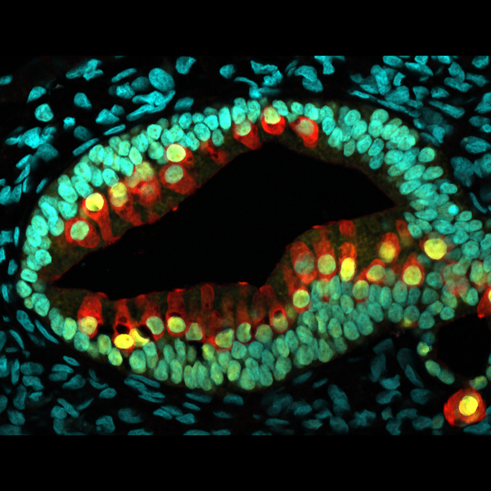 The brave new world of tumor organoids
