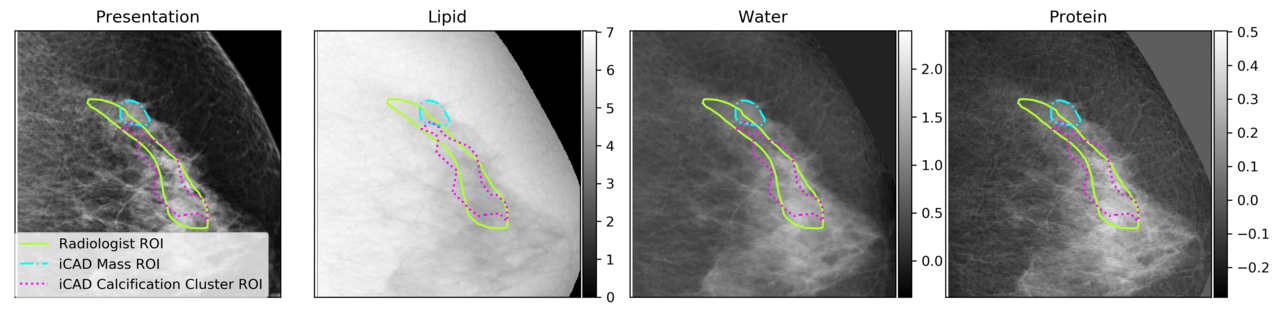 Dual-energy three-compartment breast imaging for compositional biomarkers to improve detection of malignant lesions