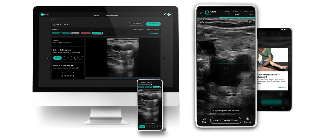 Deep vein thrombosis can be diagnosed accurately with automatic ultrasound image analysis and deep neural networks  