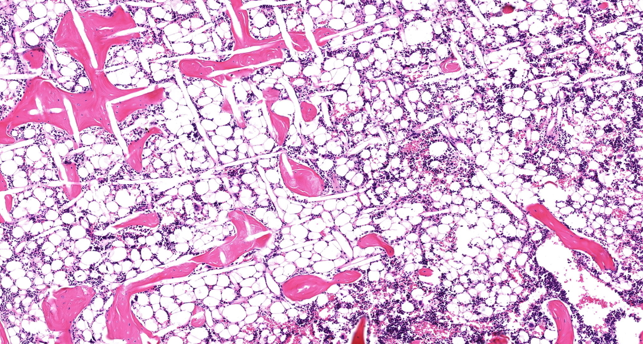 Engineering tumor microenvironments to study prostate cancer metastasis to bone