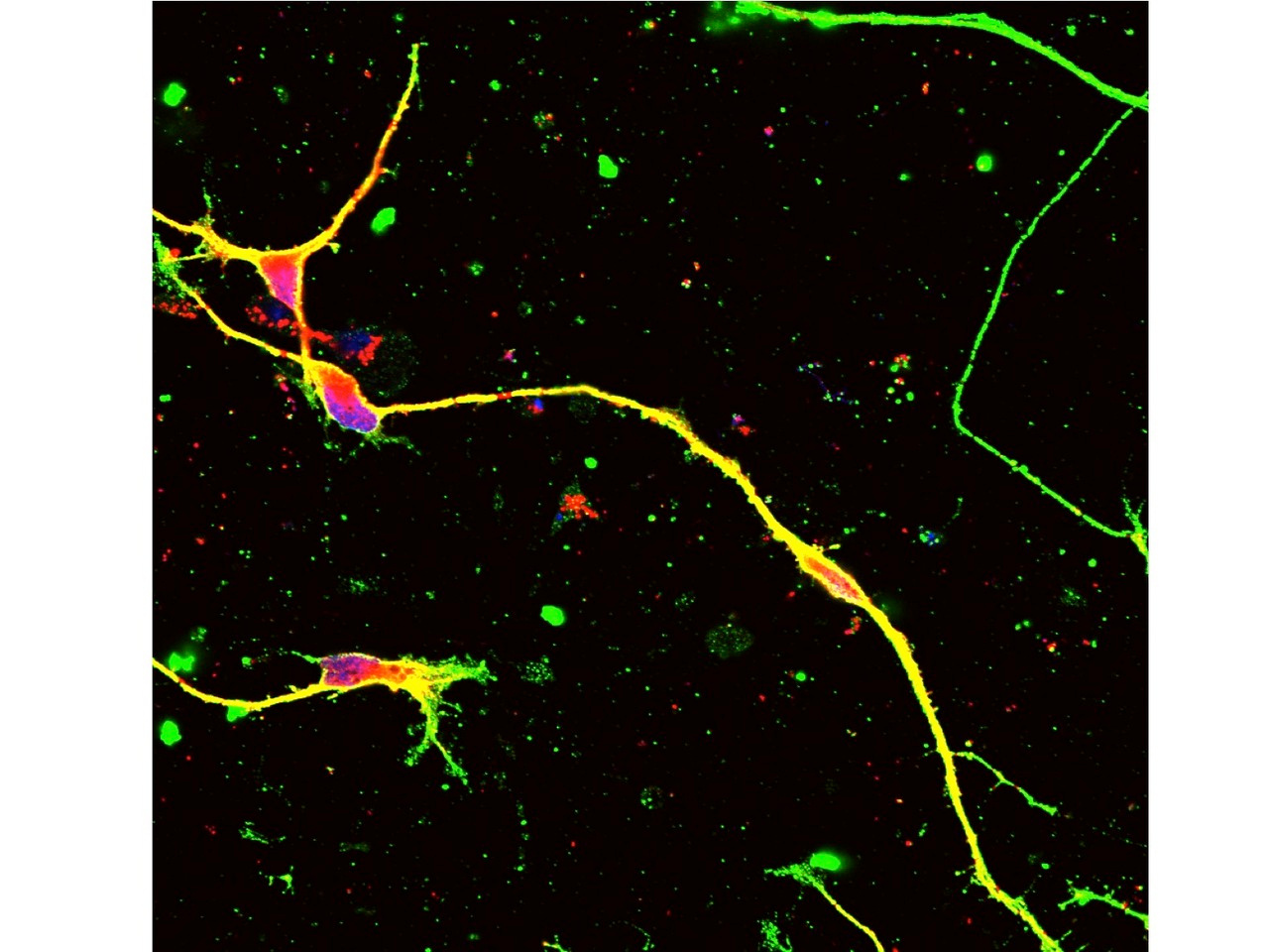 A new genome editing method by gene therapy could be a radical therapy for Charcot-Marie-Tooth disease type 1A due to duplication of 1.5 mega base genome region