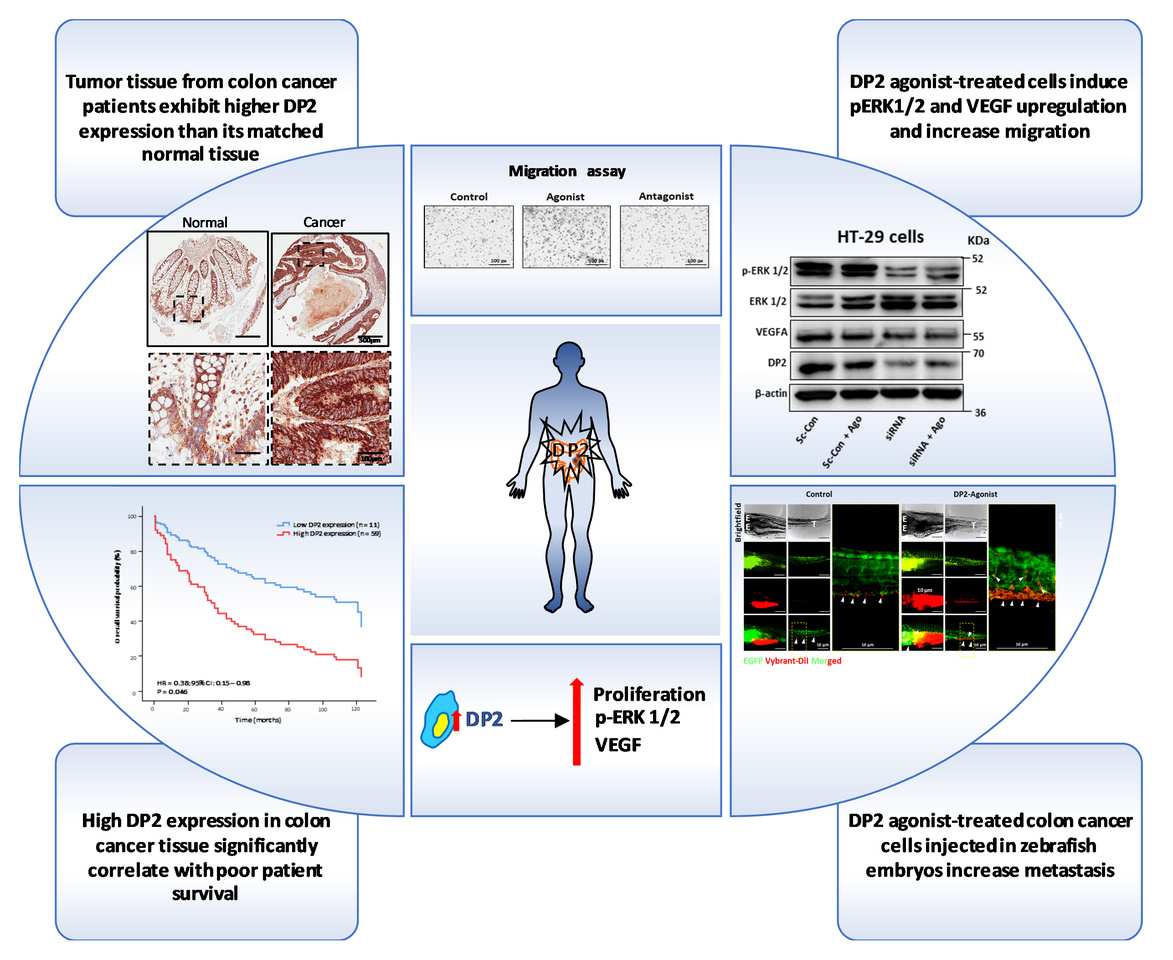 The effect of the PGD2 receptor DP2 on colon cancer patient prognosis and metastasis