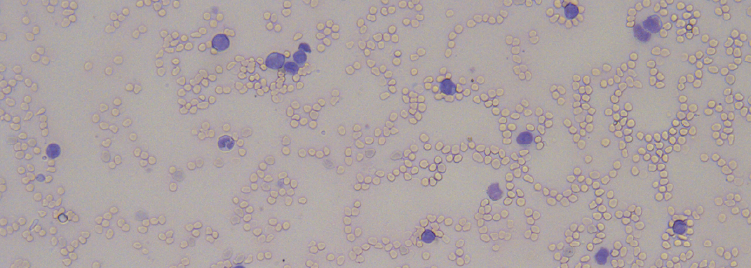 Same driver, different routes: generating a faithful model of MLL-rearranged infant leukemia