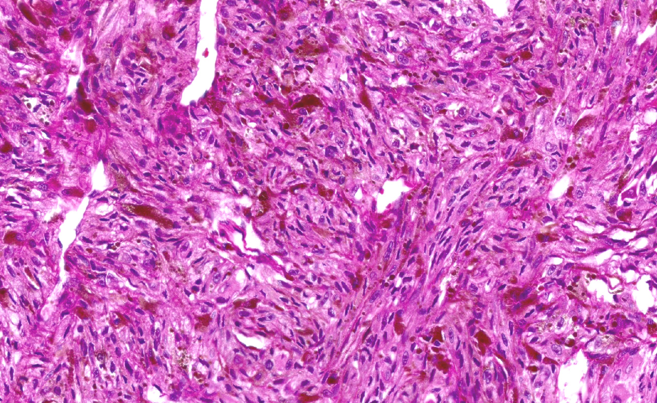 The long-term prognosis in uveal melanoma may be better than expected