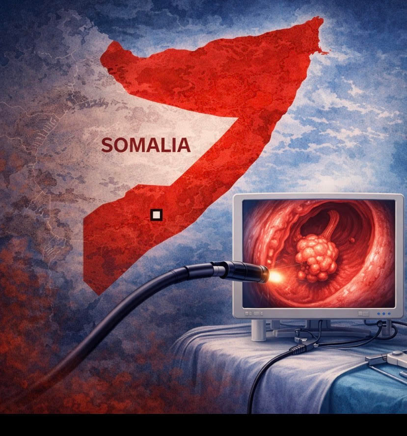 Esophageal Cancer in Somalia: Findings from new Multi-center Observational Study