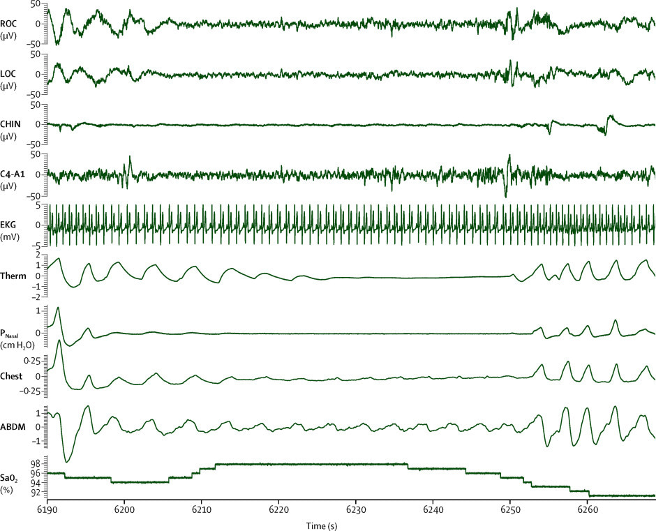 How can we diagnose sleep apnoea without bringing patients to the hospital?