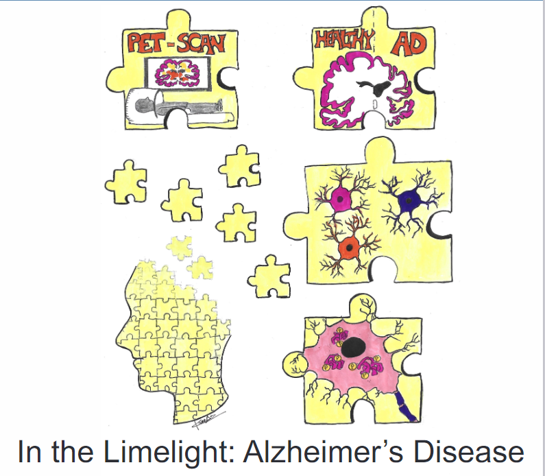Alzheimer's Disease in the Limelight
