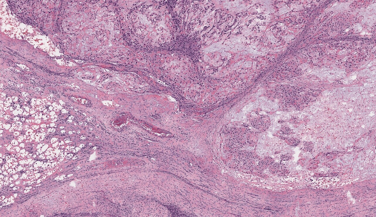 Label-free photoacoustic histology for intraoperative diagnosis of bone