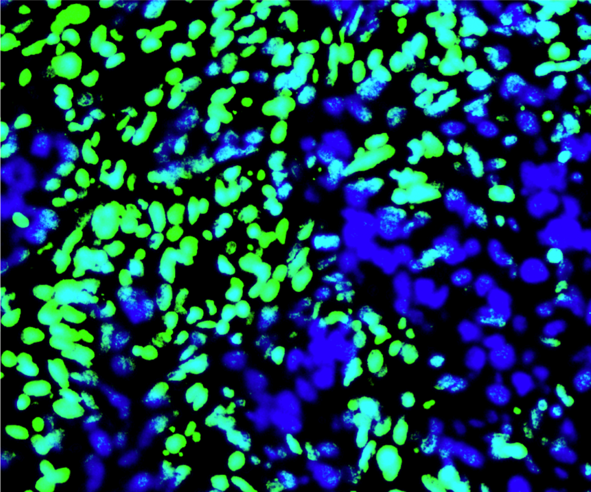 Targeting acidity: a new approach to overcome immunosuppression in pancreatic cancer