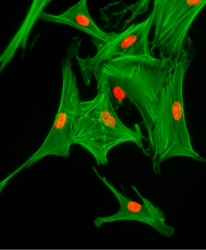 Exploring the changes in human salivary proteome after intraglandular treatment with mesenchymal stem cell treatment in previous cancer patients with salivary gland damage