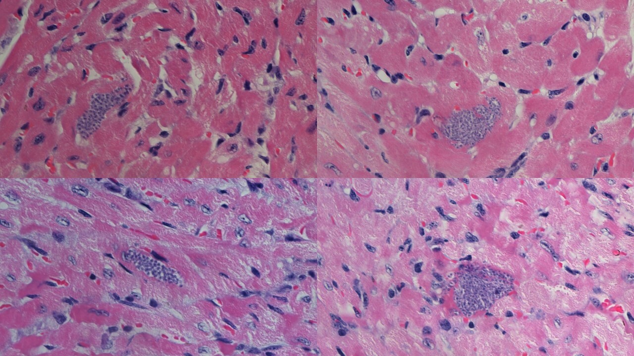 How macrophage interactions with apoptotic cells might contribute to parasite infection and pathology in Chagas disease?