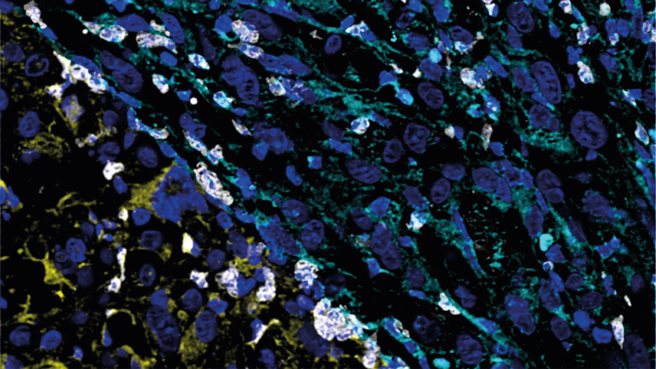 Proton boron capture therapy (PBCT) in glioblastoma model