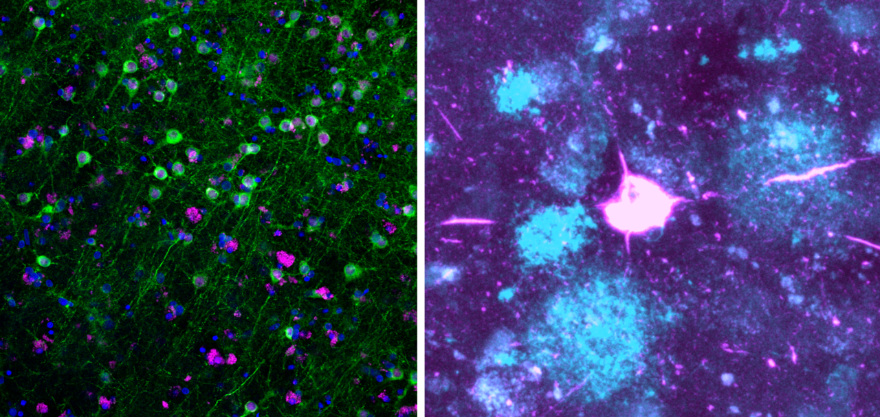 Living human brain slice cultures, Alzheimer’s disease and the power of philanthropy