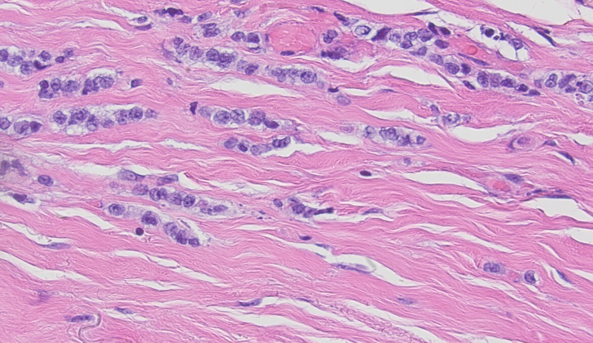 Lobular-like invasive mammary carcinoma (LiMCa): Is it a distinct entity?