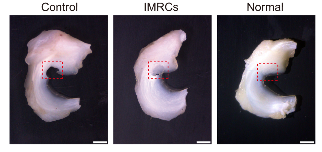 Bridging the Gap: The Evolution of a Stem Cell Therapy for Meniscus Injuries