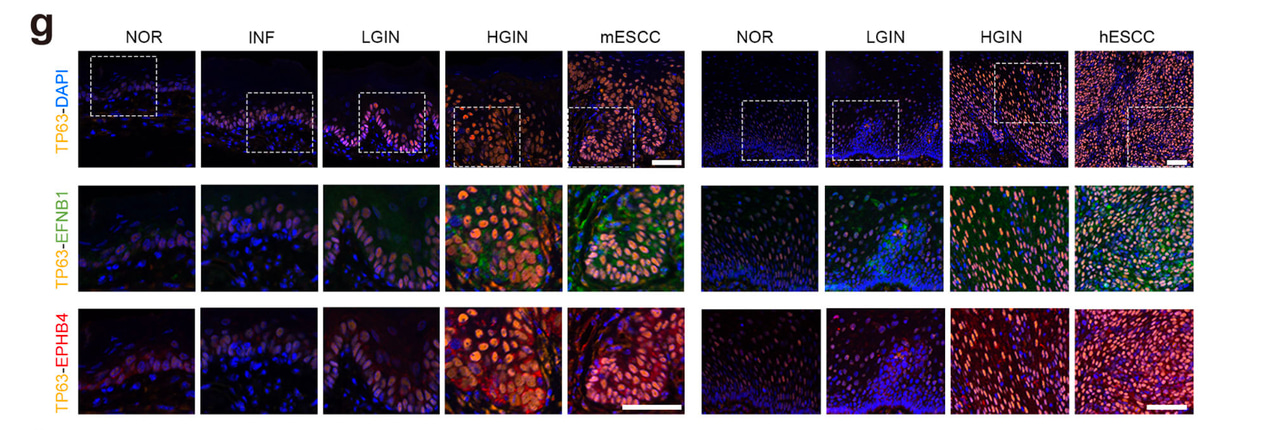 Aberrant epithelial cell interaction promotes esophageal squamous-cell carcinoma development and progression